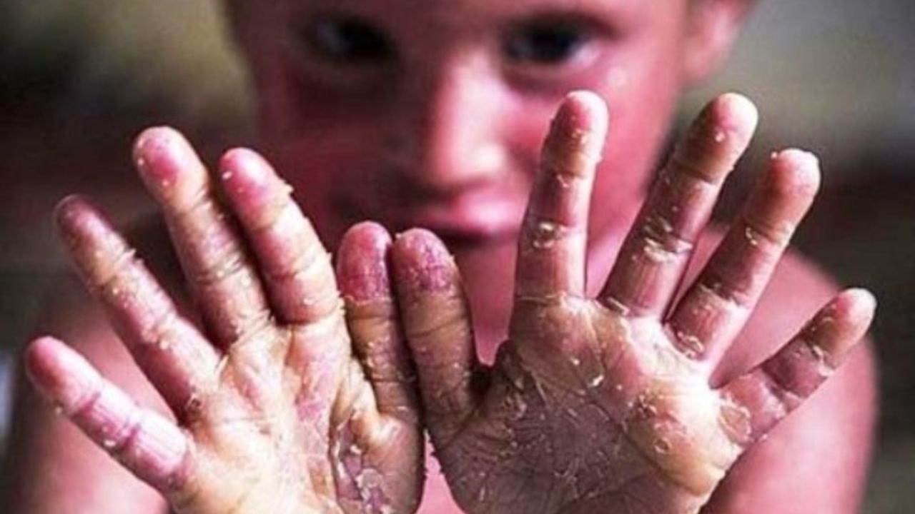 Rare Diseases (EB patients)